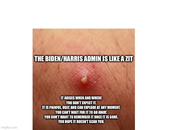 Biden Zit | THE BIDEN/HARRIS ADMIN IS LIKE A ZIT; IT ARISES WHEN AND WHERE YOU DON’T EXPECT IT.
IT IS PAINFUL, UGLY, AND CAN EXPLODE AT ANY MOMENT.
YOU CAN’T WAIT FOR IT TO GO AWAY.
YOU DON’T WANT TO REMEMBER IT ONCE IT IS GONE.
YOU HOPE IT DOESN’T SCAR YOU. | made w/ Imgflip meme maker
