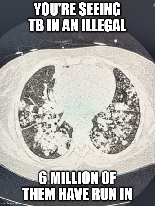 TB | YOU'RE SEEING TB IN AN ILLEGAL; 6 MILLION OF THEM HAVE RUN IN | image tagged in tb | made w/ Imgflip meme maker