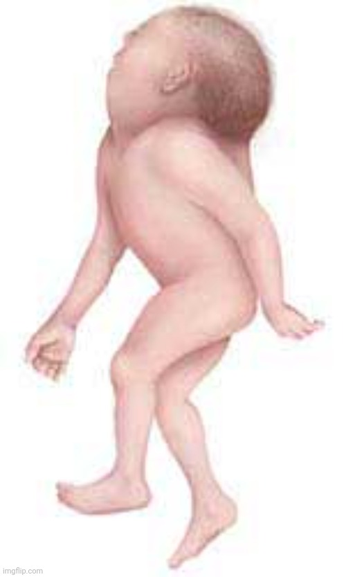 Iniencephaly | image tagged in iniencephaly | made w/ Imgflip meme maker