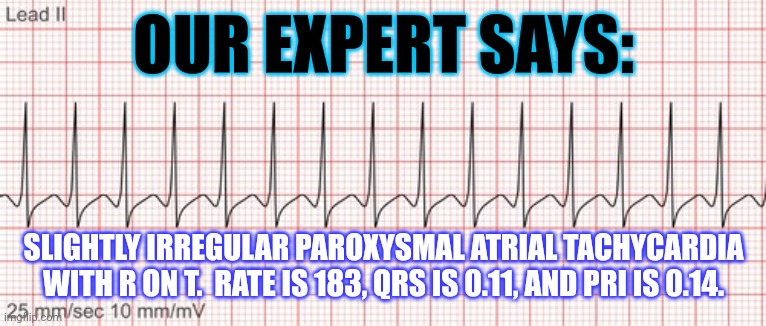 EKG interpretation | OUR EXPERT SAYS:; SLIGHTLY IRREGULAR PAROXYSMAL ATRIAL TACHYCARDIA WITH R ON T.  RATE IS 183, QRS IS 0.11, AND PRI IS 0.14. | image tagged in hospital,medical,heart | made w/ Imgflip meme maker