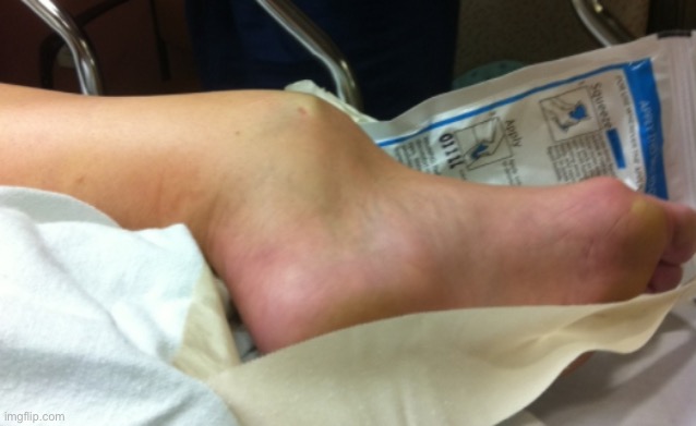 broken ankle | image tagged in broken ankle | made w/ Imgflip meme maker