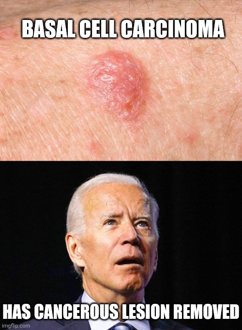 Breaking news | BASAL CELL CARCINOMA; HAS CANCEROUS LESION REMOVED | image tagged in joe biden | made w/ Imgflip meme maker
