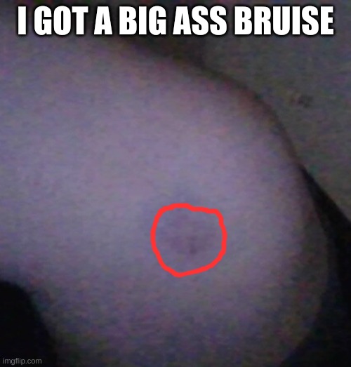 , | I GOT A BIG ASS BRUISE | made w/ Imgflip meme maker