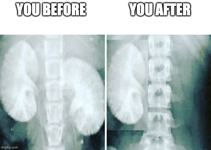 kidney x-ray before after | YOU BEFORE YOU AFTER | image tagged in kidney x-ray before after | made w/ Imgflip meme maker