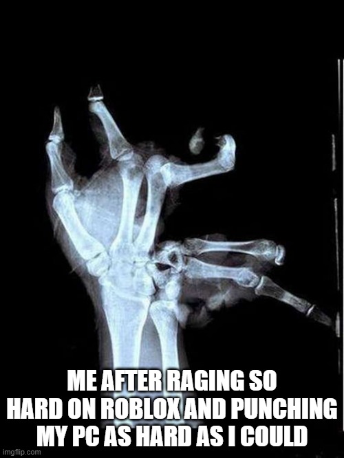 Good news: I didn't break my arm :) | ME AFTER RAGING SO HARD ON ROBLOX AND PUNCHING MY PC AS HARD AS I COULD | image tagged in broken hand | made w/ Imgflip meme maker