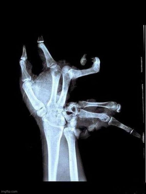 Broken Hand | image tagged in broken hand | made w/ Imgflip meme maker