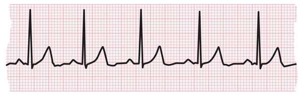High Quality ECG Blank Meme Template