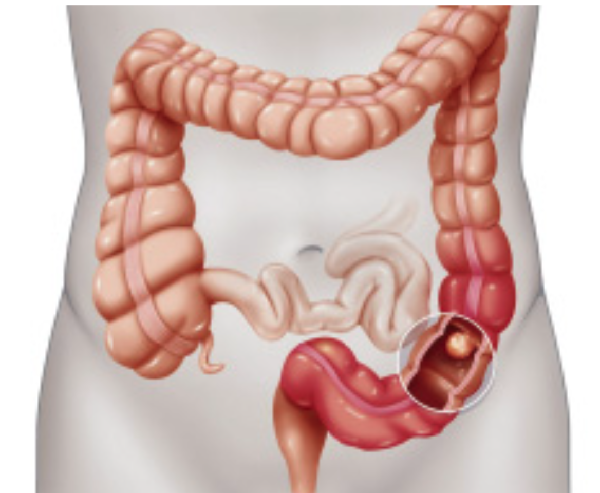 High Quality Intestinal blockage Blank Meme Template