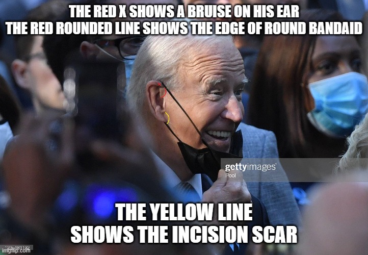THE RED X SHOWS A BRUISE ON HIS EAR
THE RED ROUNDED LINE SHOWS THE EDGE OF ROUND BANDAID; THE YELLOW LINE SHOWS THE INCISION SCAR | made w/ Imgflip meme maker