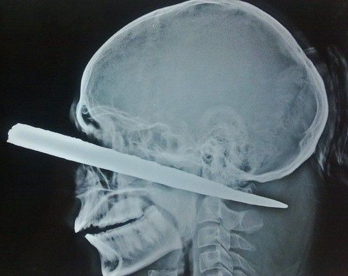 lobotomy Blank Meme Template