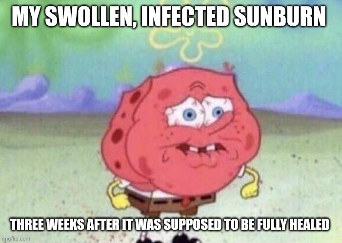 The sunburn is infected now | MY SWOLLEN, INFECTED SUNBURN; THREE WEEKS AFTER IT WAS SUPPOSED TO BE FULLY HEALED | image tagged in spongebob holding breath | made w/ Imgflip meme maker