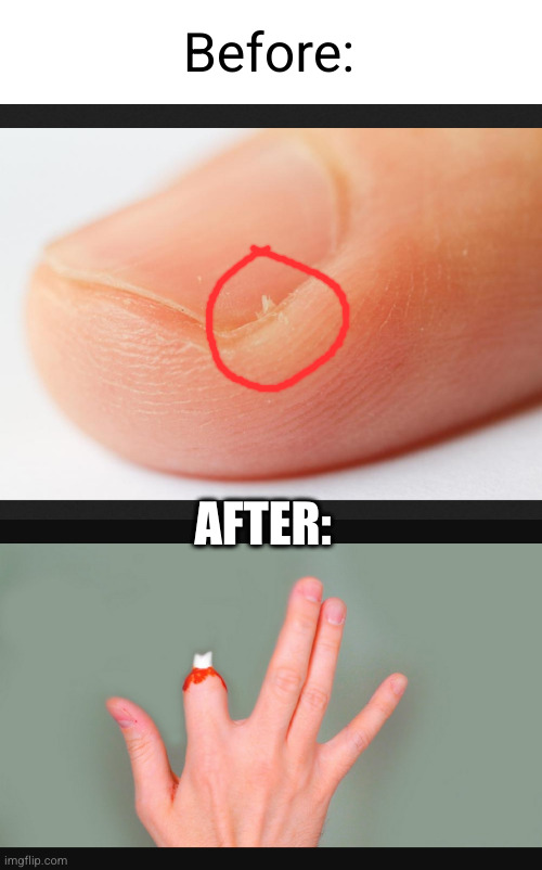 hangnail is just the worst... | Before:; AFTER: | image tagged in hangnail,finger,blood,death,relatable,so true | made w/ Imgflip meme maker