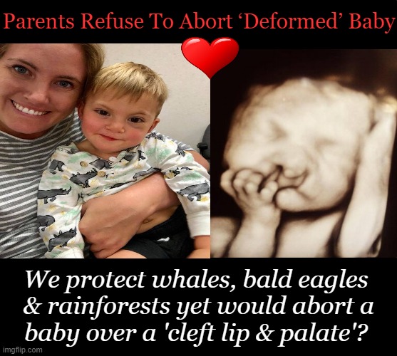 Choose Life. Your Mom Did. | Parents Refuse To Abort ‘Deformed’ Baby; We protect whales, bald eagles 
& rainforests yet would abort a
baby over a 'cleft lip & palate'? | image tagged in politics,life,gift of life,abortion,choose wisely,babies | made w/ Imgflip meme maker
