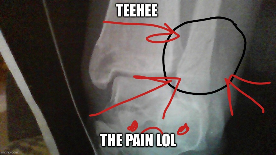 tehhee | TEEHEE; THE PAIN LOL | image tagged in broken leg | made w/ Imgflip meme maker
