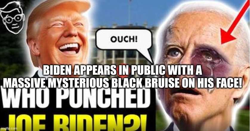 Biden Appears in Public With a Massive Mysterious Black Bruise on His ...