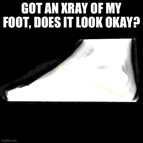 It slightly hurts | GOT AN XRAY OF MY FOOT, DOES IT LOOK OKAY? | made w/ Imgflip meme maker