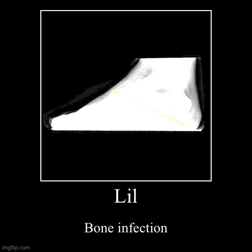 Lil bone infection | Lil | Bone infection | image tagged in funny,demotivationals | made w/ Imgflip demotivational maker
