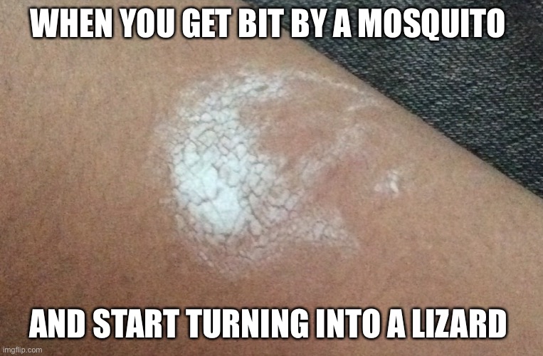 (Its just dried bug cream) | WHEN YOU GET BIT BY A MOSQUITO; AND START TURNING INTO A LIZARD | image tagged in lizard me,heheh | made w/ Imgflip meme maker