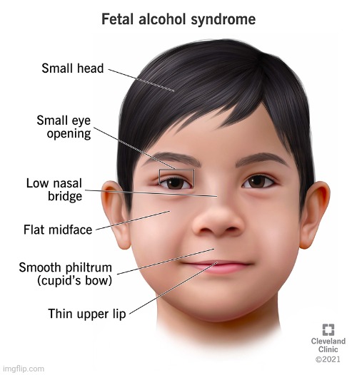 Fetal Alcohol Syndrome | image tagged in fetal alcohol syndrome | made w/ Imgflip meme maker