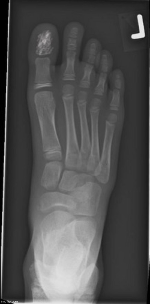 Did a photoshop, this is pretty much what my xray looked like, probably gonna get my toe removed | made w/ Imgflip meme maker
