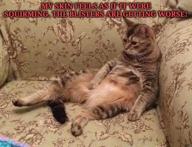 Mocha Chilling | MY SKIN FEELS AS IF IT WERE SQUIRMING. THE BLISTERS ARE GETTING WORSE! | image tagged in mocha chilling | made w/ Imgflip meme maker