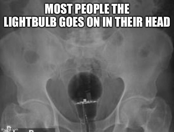 Dude, you got that bassackwards! | MOST PEOPLE THE LIGHTBULB GOES ON IN THEIR HEAD | image tagged in lightbulb,anus,xray | made w/ Imgflip meme maker