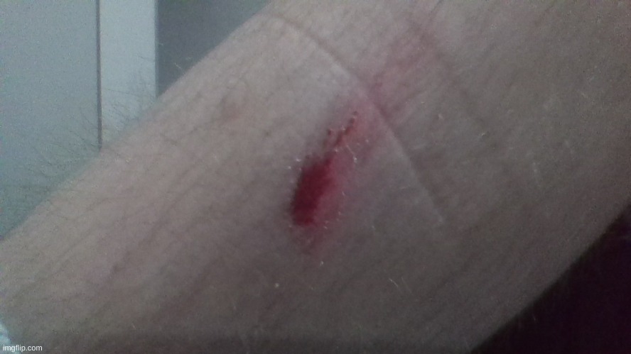 My fricking leg hurts and dont ask what happened | made w/ Imgflip meme maker