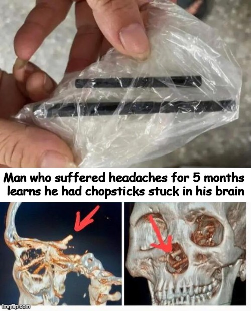 He was in a drunken brawl months ago & didn't recall how the stabbing pain had originated. | Man who suffered headaches for 5 months 
learns he had chopsticks stuck in his brain | image tagged in dark humor,chopsticks,don't belong up your nose,headaches,doctors,news you can use | made w/ Imgflip meme maker