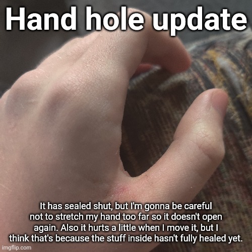 It looks more red IRL than it does on camera. | Hand hole update; It has sealed shut, but I'm gonna be careful not to stretch my hand too far so it doesn't open again. Also it hurts a little when I move it, but I think that's because the stuff inside hasn't fully healed yet. | made w/ Imgflip meme maker