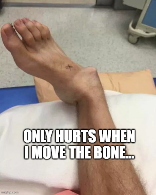 Broken Ankle | ONLY HURTS WHEN I MOVE THE BONE... | image tagged in broken ankle | made w/ Imgflip meme maker