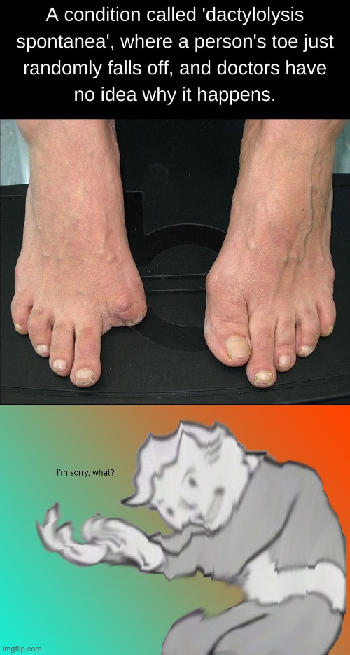 image tagged in i'm sorry what,toe,disease,toes,fall,off | made w/ Imgflip meme maker