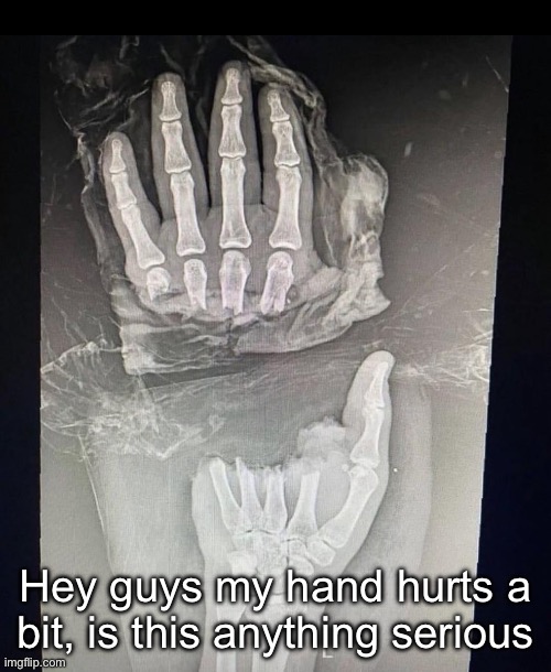 Hey guys my hand hurts a bit, is this anything serious | made w/ Imgflip meme maker
