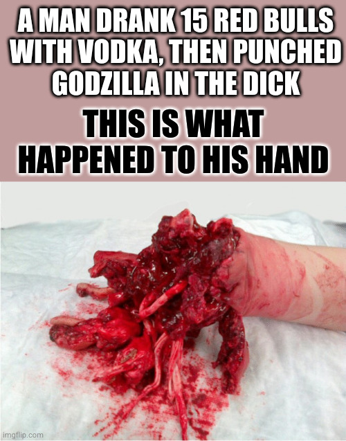 At least he has a cool story | A MAN DRANK 15 RED BULLS
WITH VODKA, THEN PUNCHED
GODZILLA IN THE DICK; THIS IS WHAT HAPPENED TO HIS HAND | image tagged in clickbait | made w/ Imgflip meme maker