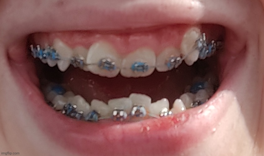 Reposting my braces/mouth reveal because why not | made w/ Imgflip meme maker