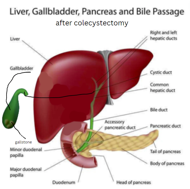 High Quality liver, gallbladder and pancreas after cholecystectomy Blank Meme Template