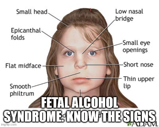 Is this you? | FETAL ALCOHOL SYNDROME. KNOW THE SIGNS | image tagged in fast food | made w/ Imgflip meme maker