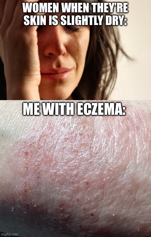 Gross right? This is a real picture of my arm… | WOMEN WHEN THEY’RE SKIN IS SLIGHTLY DRY:; ME WITH ECZEMA: | image tagged in memes,first world problems | made w/ Imgflip meme maker