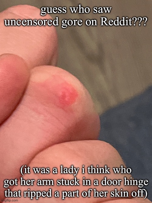 burn on finger :( | guess who saw uncensored gore on Reddit??? (it was a lady i think who got her arm stuck in a door hinge that ripped a part of her skin off) | made w/ Imgflip meme maker