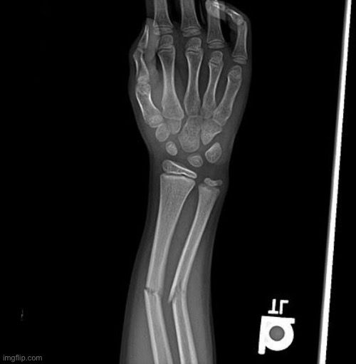 Broken bone | image tagged in broken bone | made w/ Imgflip meme maker