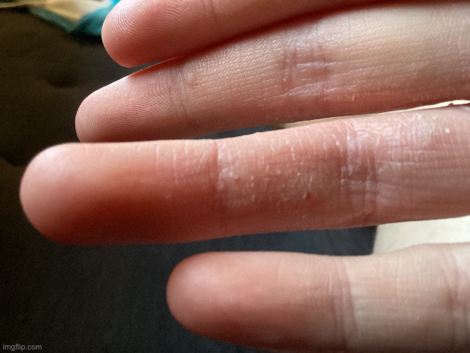 Finger eczema | made w/ Imgflip meme maker