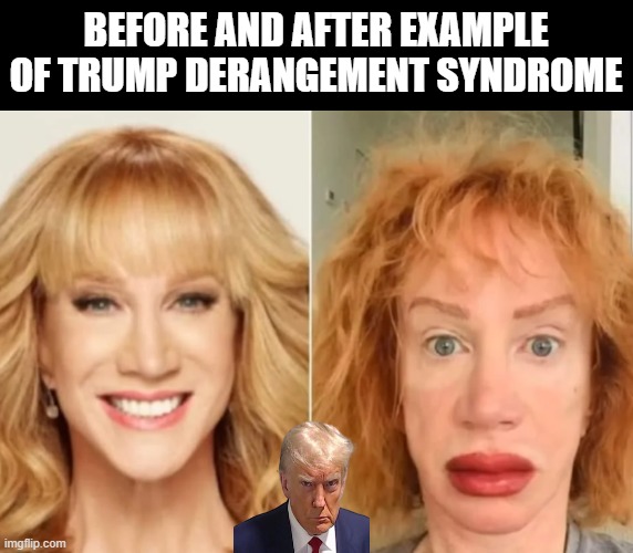 Stage four Trump derangement syndrome | BEFORE AND AFTER EXAMPLE OF TRUMP DERANGEMENT SYNDROME | image tagged in trump,maga,kathy griffin,kathy griffin tolerance | made w/ Imgflip meme maker