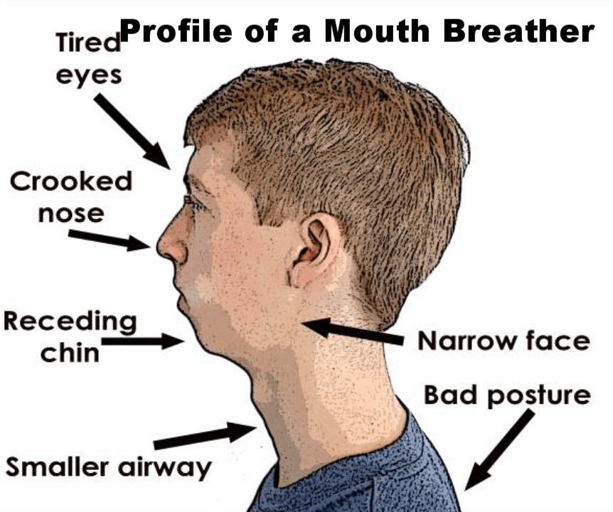 High Quality Profile of a Mouth Breather Blank Meme Template