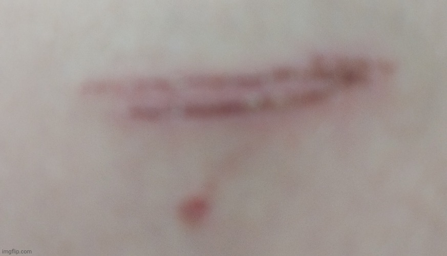 Stupid wound i got yesterday | made w/ Imgflip meme maker