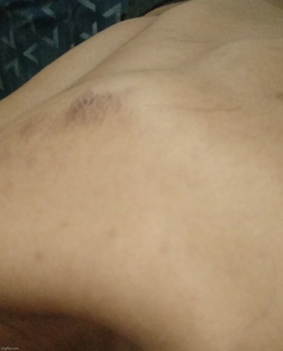 little scab from squatting a few days ago, nothing serious :p | made w/ Imgflip meme maker