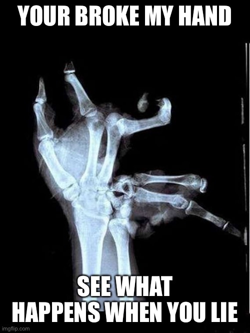 Broken Hand | YOUR BROKE MY HAND; SEE WHAT HAPPENS WHEN YOU LIE | image tagged in broken hand | made w/ Imgflip meme maker