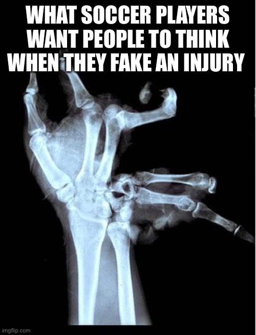 Can anyone relate to this? | WHAT SOCCER PLAYERS WANT PEOPLE TO THINK WHEN THEY FAKE AN INJURY | image tagged in broken hand,soccer,you faking it you dingus | made w/ Imgflip meme maker