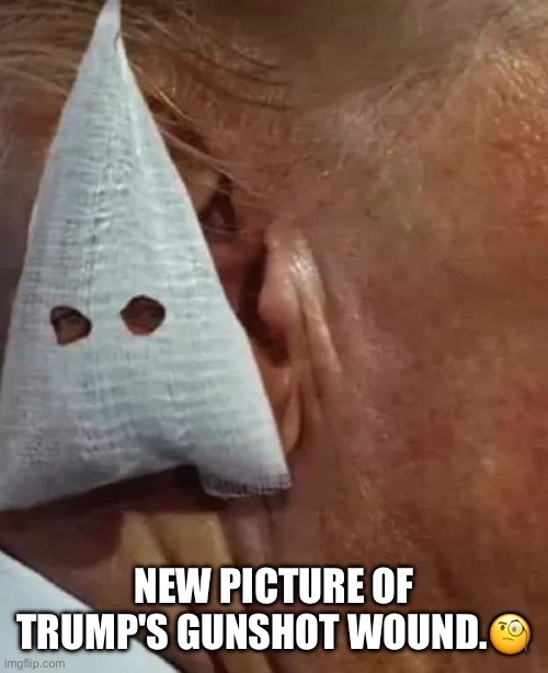 Trump sustained 2 cm-wide gunshot wound to ear, his former physician says. | NEW PICTURE OF TRUMP'S GUNSHOT WOUND.🧐 | image tagged in donald trump,fake wounds,liar,con man,sexual predator,racist | made w/ Imgflip meme maker