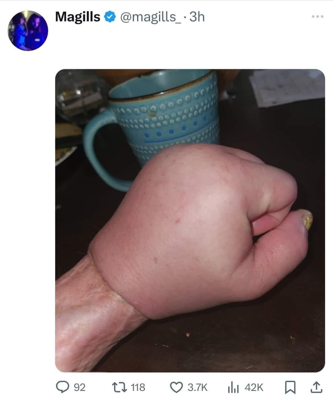 Fist swollen Blank Meme Template