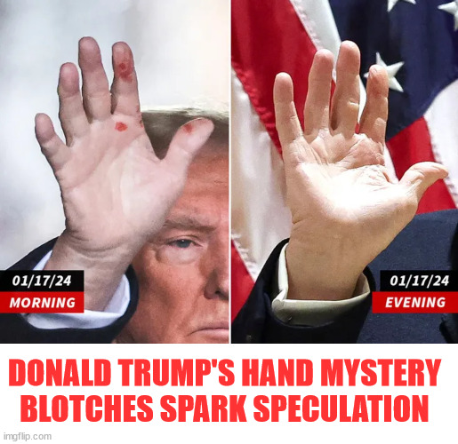 Premonition? | DONALD TRUMP'S HAND MYSTERY BLOTCHES SPARK SPECULATION | image tagged in mystery bloody hand,la bloodadonald,a warning from god | made w/ Imgflip meme maker
