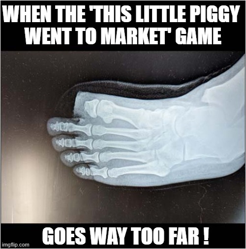 Back At The X Ray Department Again ! | WHEN THE 'THIS LITTLE PIGGY
 WENT TO MARKET' GAME; GOES WAY TOO FAR ! | image tagged in x ray,toe,amputated,nursery rhymes,little piggy,dark humour | made w/ Imgflip meme maker